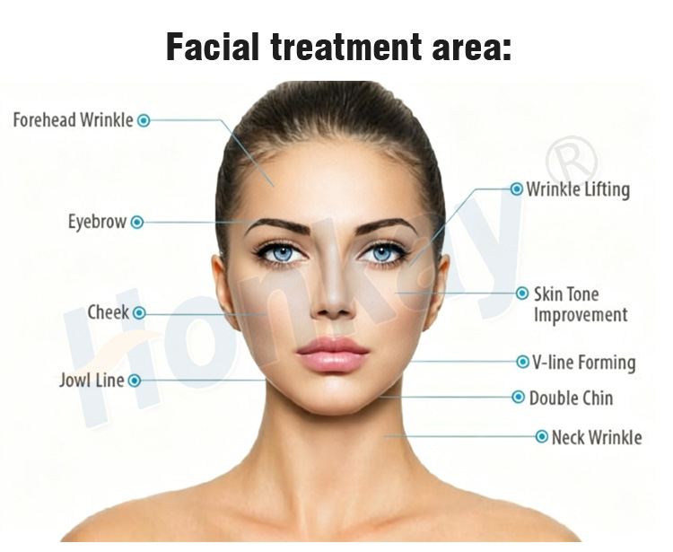 Facial treatment area chart - forehead wrinkle, eyebrow, cheek, jowl line, double chin, neck wrinkle