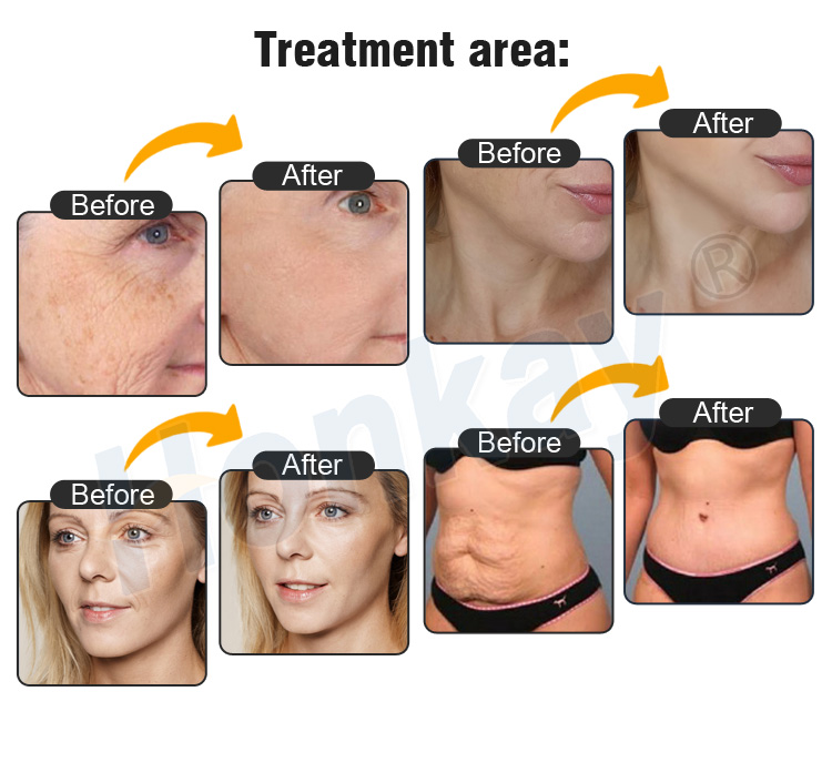 Treatment area before and after images supplied by the manufacturer