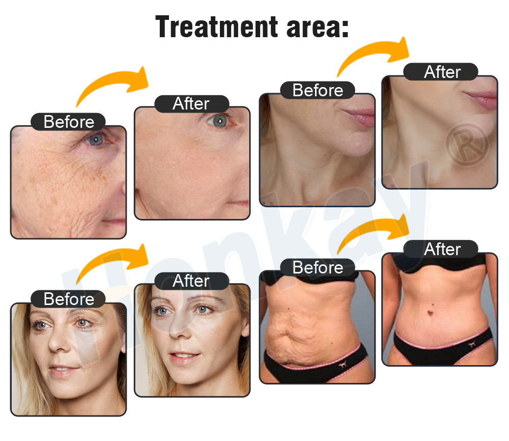 Treatment area before and after images supplied by the manufacturer