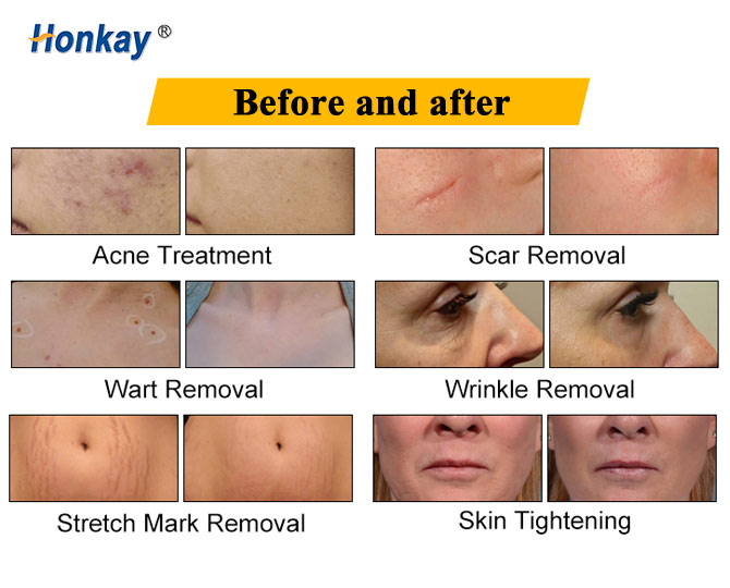 fractional co2 laser machine price