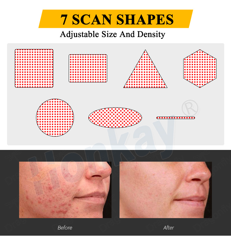 portable co2 fractional laser machine