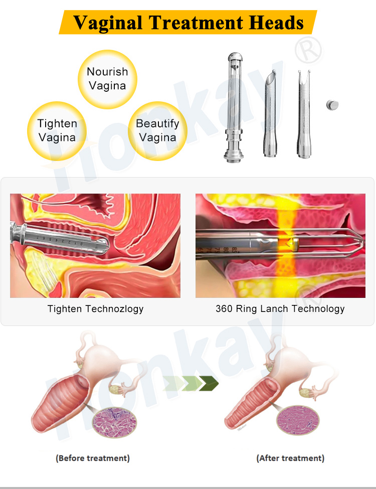portable co2 fractional laser machine