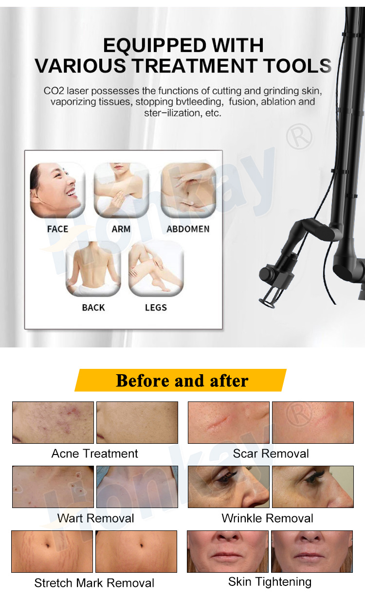 portable co2 fractional laser machine