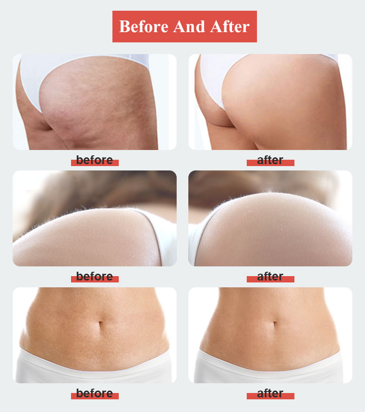 Endosfera Therapy Cellulite Rreatment beofre and after