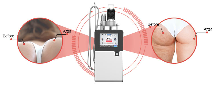 Endosfera Therapy Cellulite Rreatment