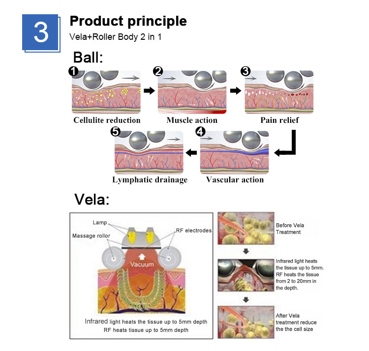 Velashape Endosfera cellulite treatment