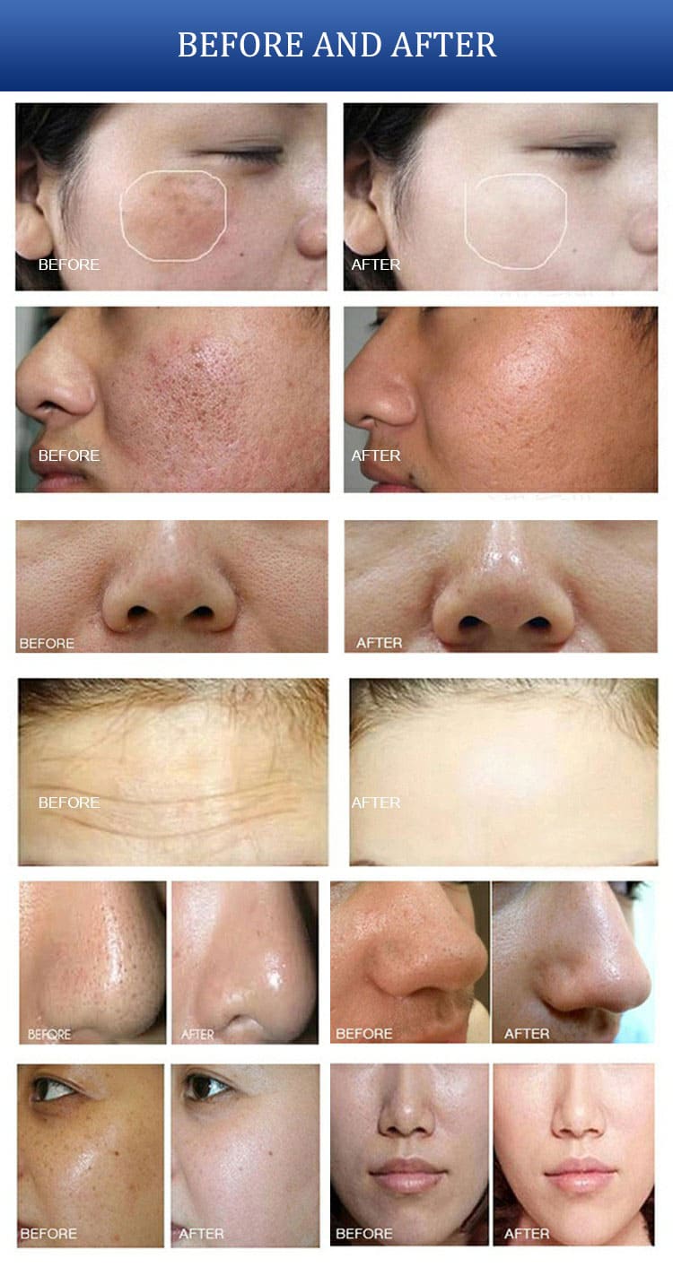 hydra beauty machine before after