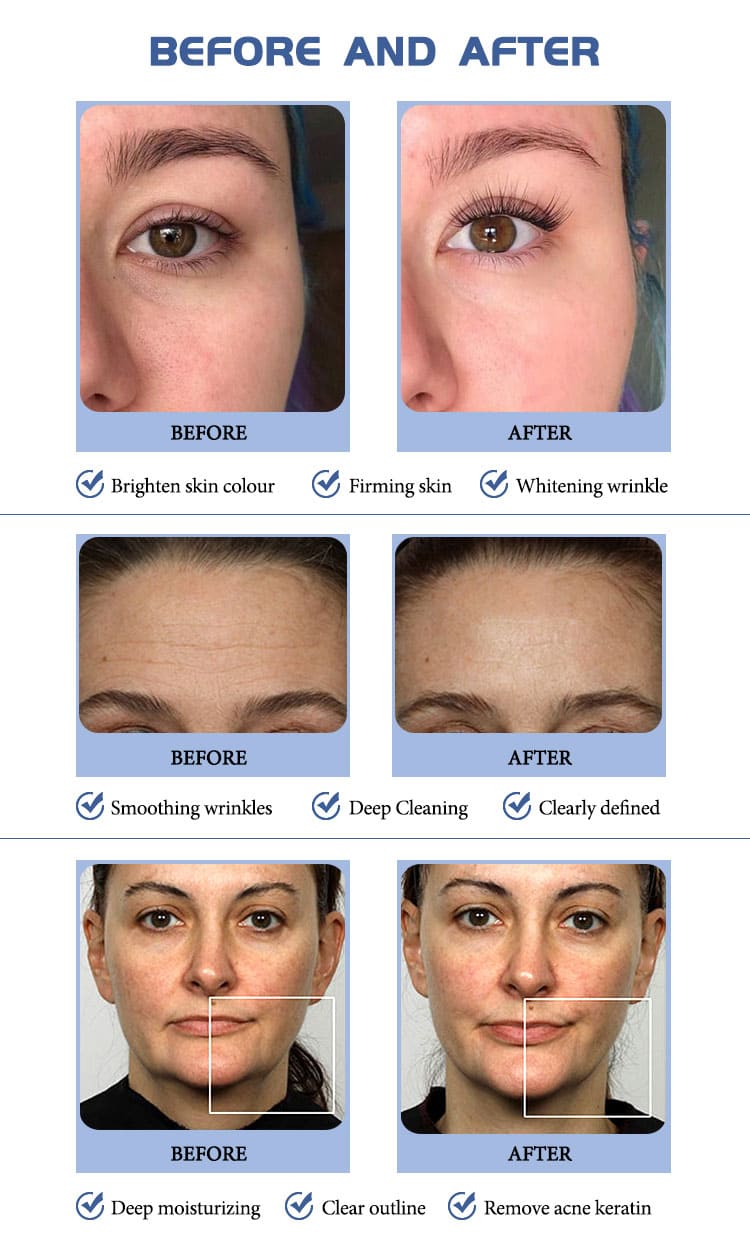 hydra dermabrasion facial equipment before after
