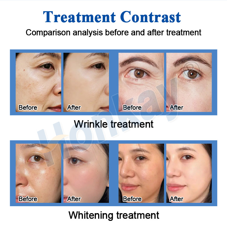 hydro dermabrasion hydra facial machine