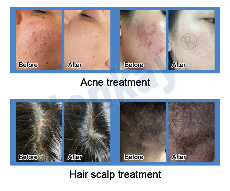 hydro dermabrasion hydra facial machine