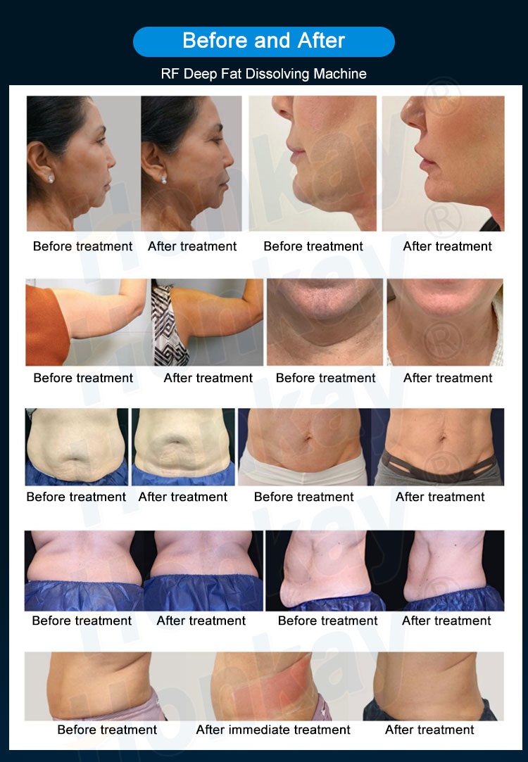 trusculpt machine befpre and after