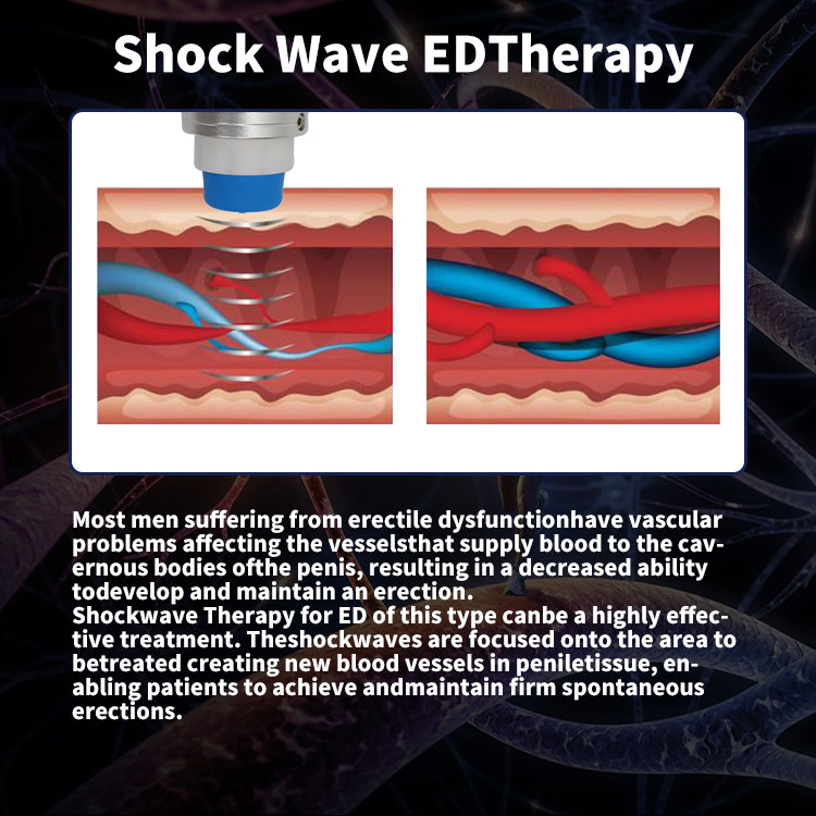 shockwave therapy at home