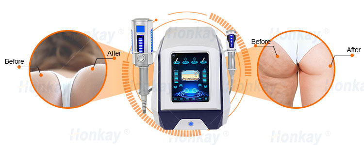 Endospheres Therapy Machine Compressive Microvibration