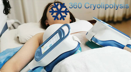 360 cryolipolysis machine