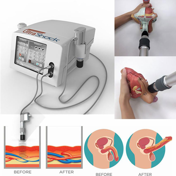 acoustic wave therapy machine for erectile dysfunction