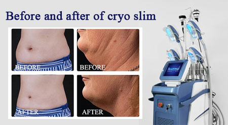 before and after of cryoslim treatment