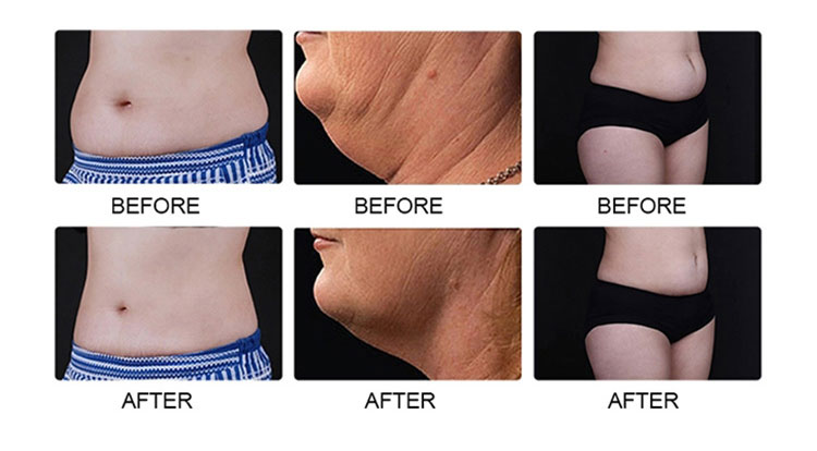 cryotherpay slimming machine before and after