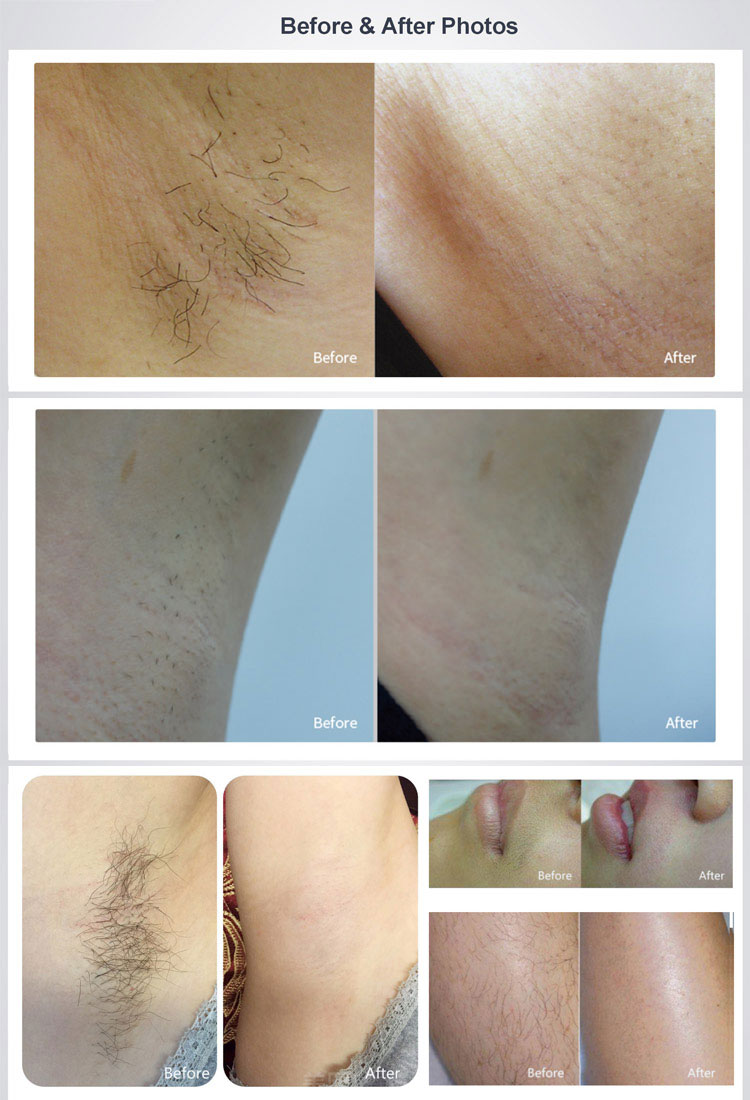 hair removal before and after