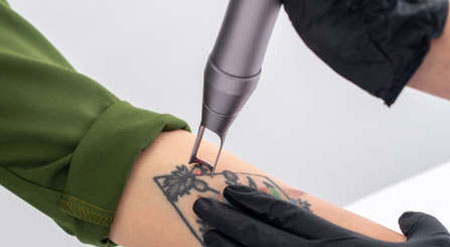 picosecond laser tattoo removal machine