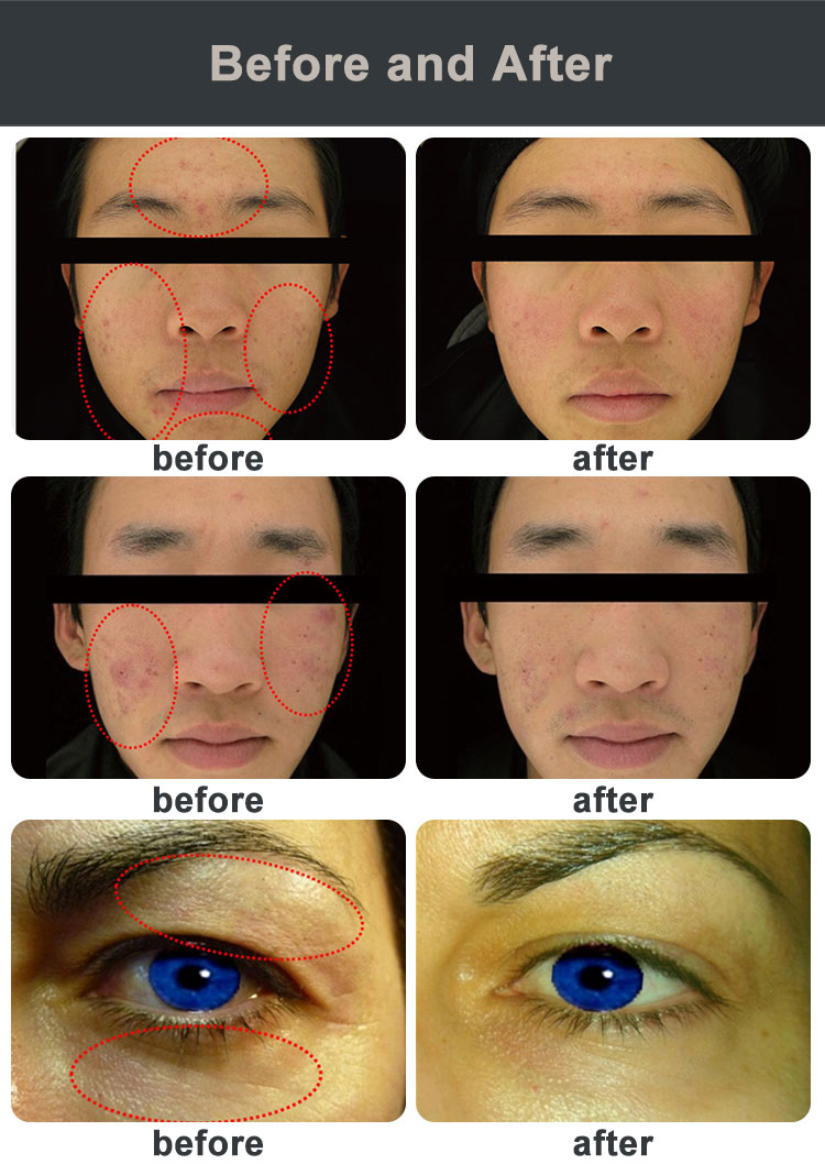 plasma pen eye lift fibroblast skin tightening befpre after