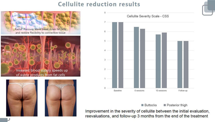 shockwave therapy cellulite reduction