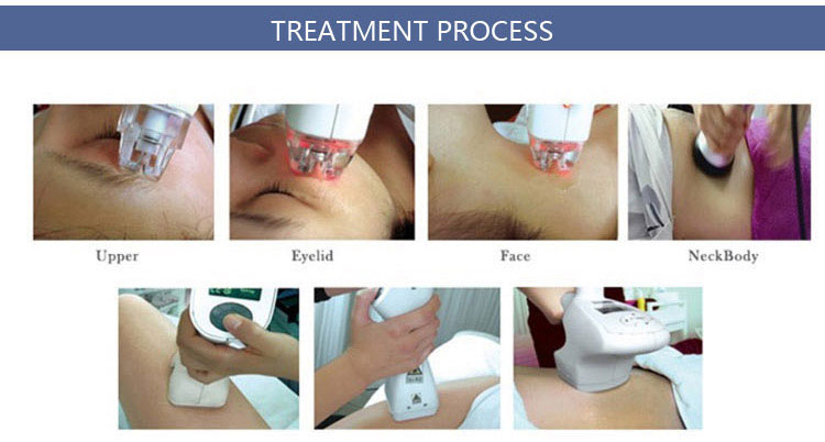 vacuum rf roller cavitation treatment