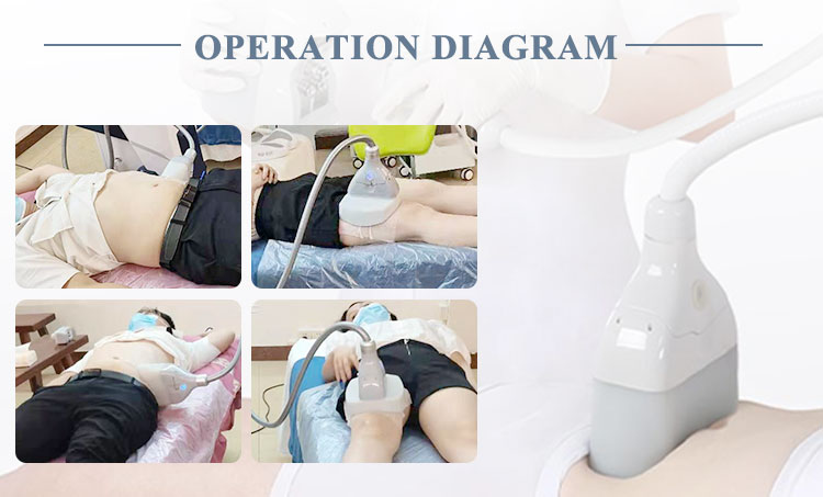 cryo lipo machine