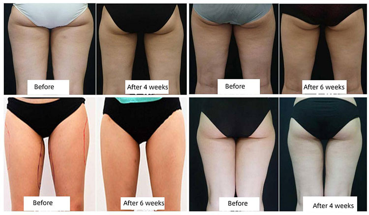 cryo slimming machines before after