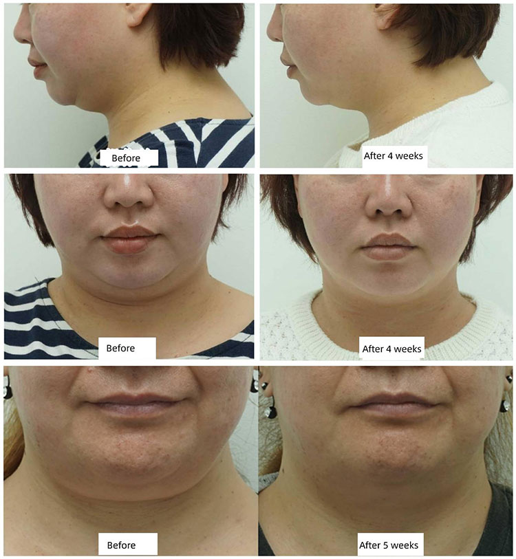 cryolipolysis machine before after