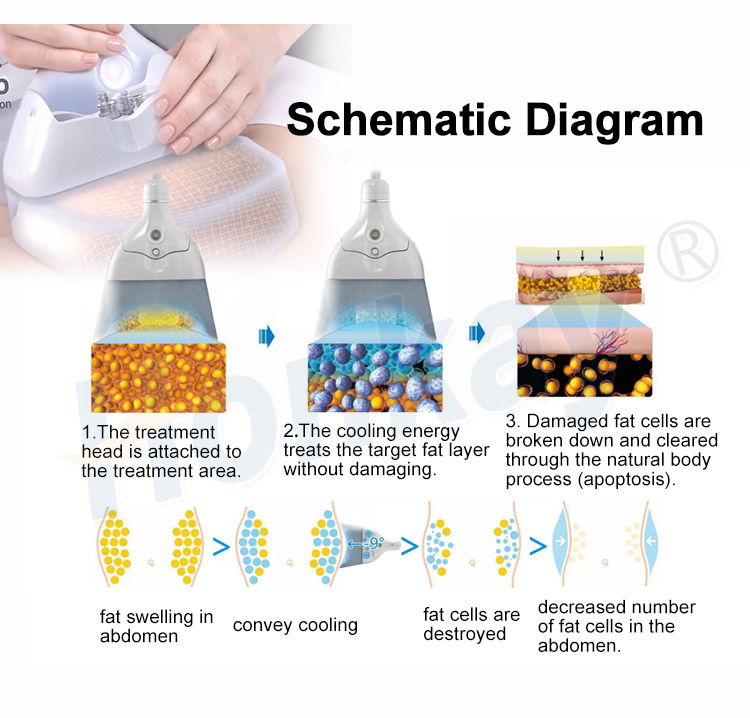 cryolipolysis machine cost