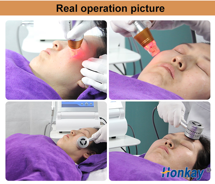 fractional rf microneedling machine