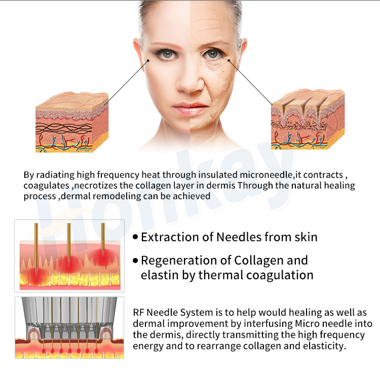 fractional microneedle machine