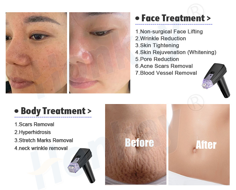 rf microneedling machine for sale