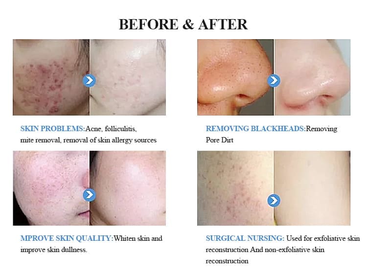 professional hydra dermabrasion facial machine