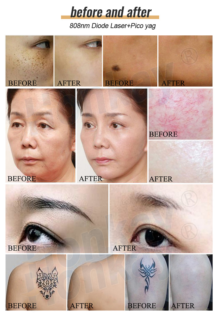 808nm Diode Laser pico yag hair removal Machine