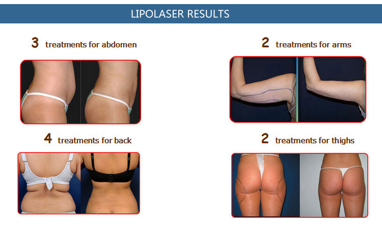 what is lipo laser weight loss