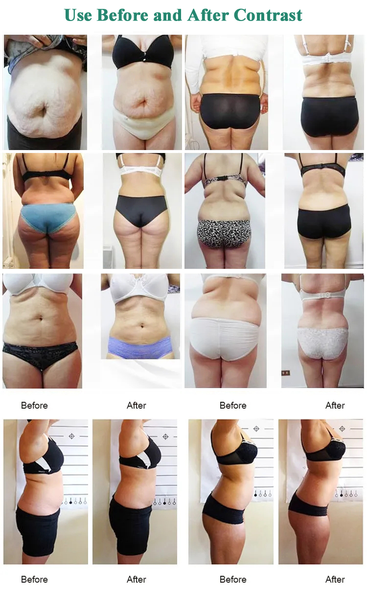 lipo laser before after