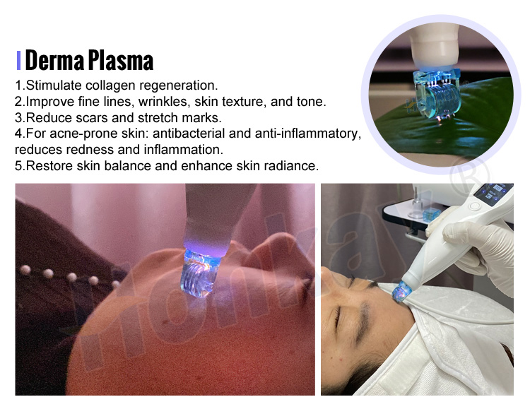 plasma pen wrinkle removal