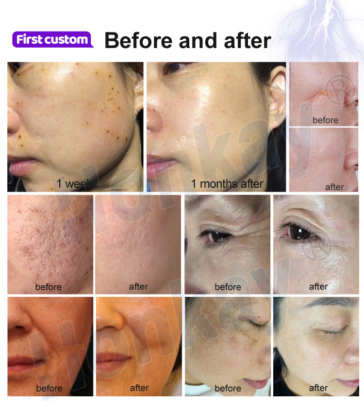 cold plasma facial device