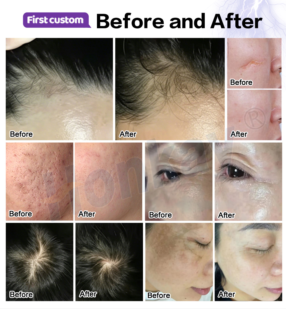 Before and after results for scalp regrowth, scars, acne marks and pigmentation
