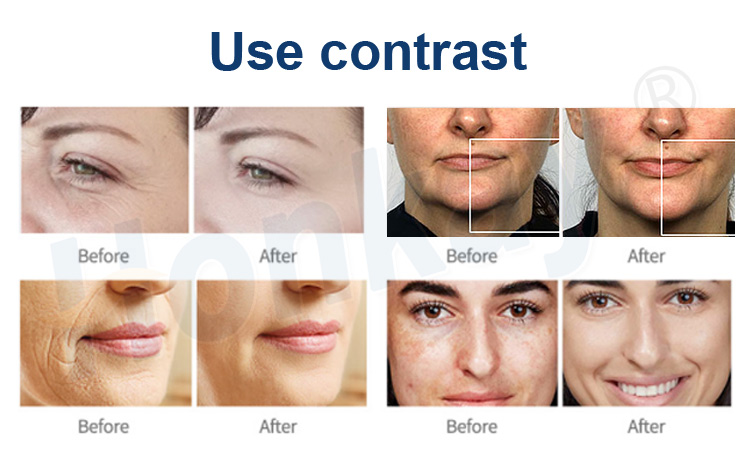 plasma pen eye lift cost