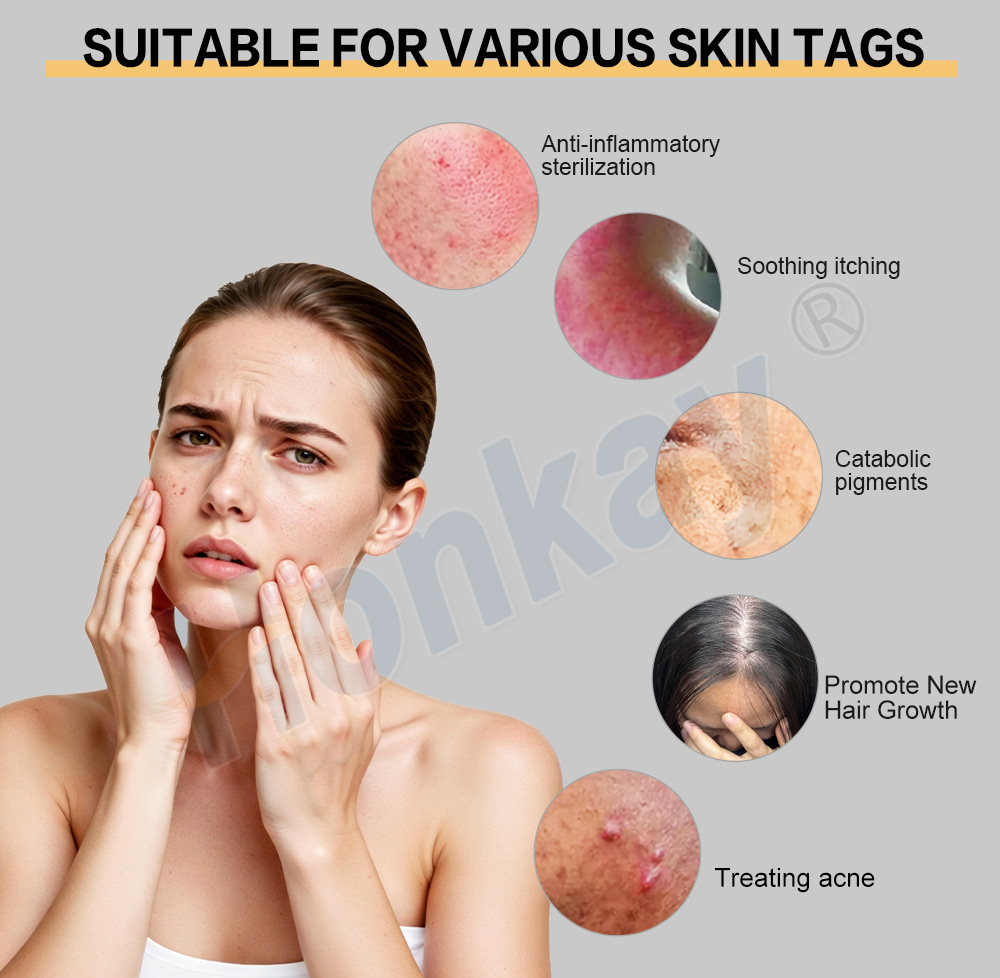 skin conditions treated by the handheld ozone comb plasma pen