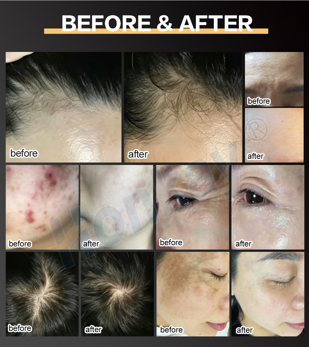 before and after results shown by the manufacturer for six treatment areas